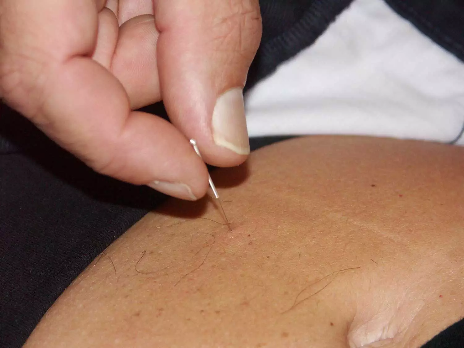 TCM Acupuncture in tummy